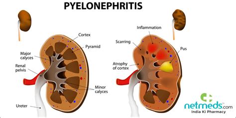 Pyelonephritis