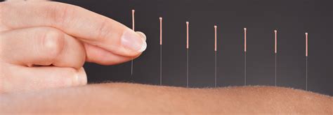 Perfect Balance Acupuncture In Meath