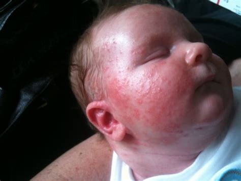Baby Eczema Wont Go Away Babycentre