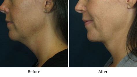 Double Chin Liposuction Redefining Your Contours With Smartlipo