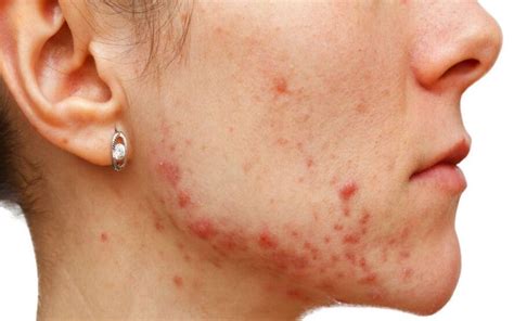 O Que São Comedões E Acne Comedónica Tookmed