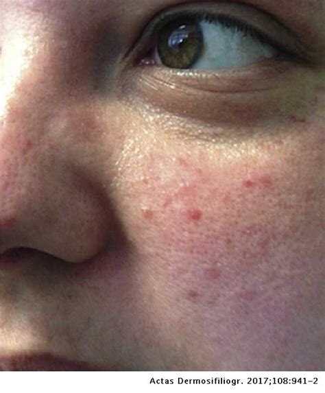 Erythematous Lesions On The Face And Papules On The Trunk Of A Young
