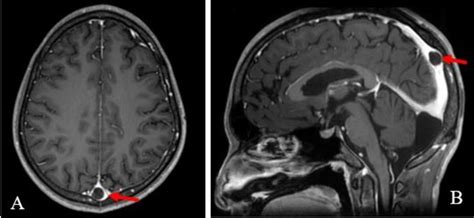 Giant Arachnoid Granulation A Axial And B Sagittal Post Contrast