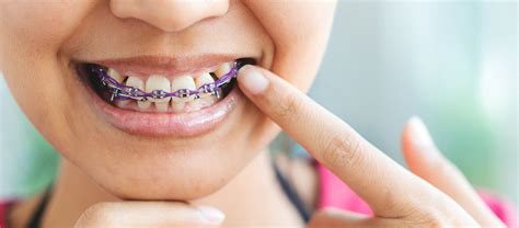 Dealing With Loose Brackets 3 Easy Steps Smile Doctors