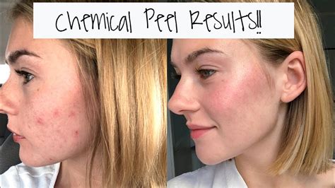 Acne Scars Before And After Chemical Peel