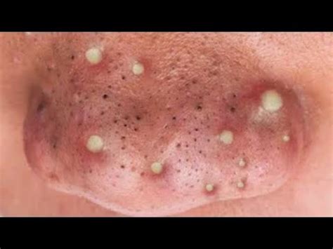 As you can imagine, these pops are some of the gnarliest dr. *NEW* 2019 SATISFYING PIMPLE POPPING & BLACKHEAD REMOVAL ...
