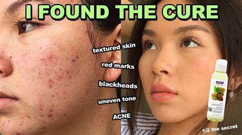 How To Fix Acne Red Marks Andtextured Skin In 1 Week It Works Youtube