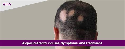 Alopecia Areata Causes Symptoms Treatment How To Stop It