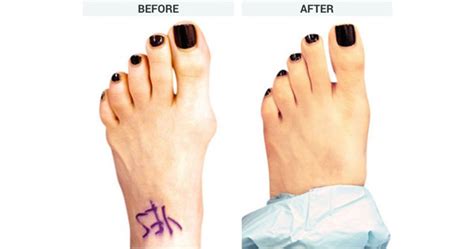 Bunion Exercises Before And After 6 Exercises To Fix Bunions Youtube