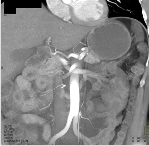 Aortic Valvular Calcification With Aortic Stenosis And Dilated