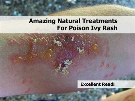 Amazing Natural Treatments For Poison Ivy Poison Ivy Treatment