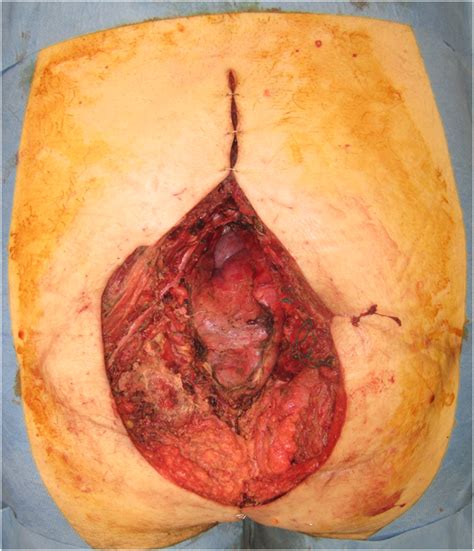 A Free Latissimus Dorsi Myocutaneous Flap Was Selected For