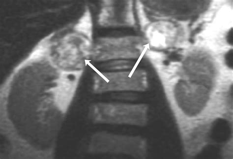 MRI Of Adrenal And Extraadrenal Pheochromocytoma AJR