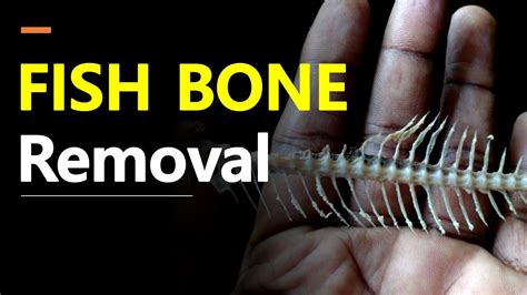 How To Remove Fishbone In Your Throat Youtube