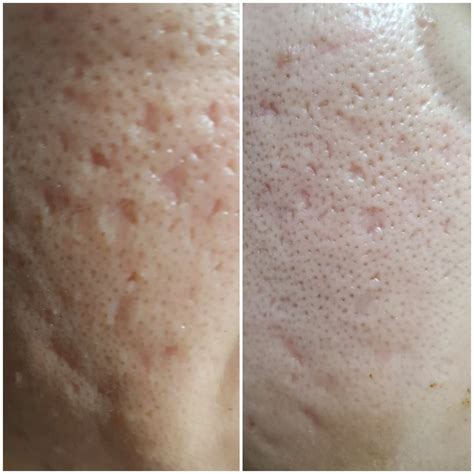 Improvement In Pitted Scars Tretinoin Aha30 Rtretinoin