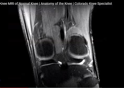 Mri Of A Normal Knee —