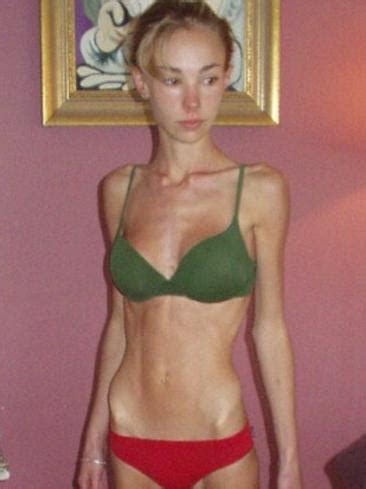 Formerly Anorexic Teenager To Beauty Champion Hattie Boydles Story