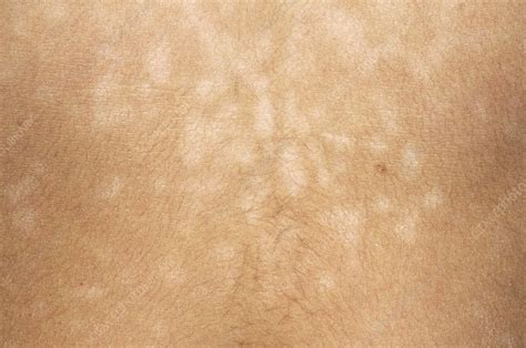Pityriasis Versicolor Skin Infection Stock Image M