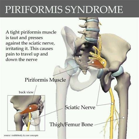 อนดบหนง 104 ภาพพนหลง Piriformis Syndrome กายภาพ บา บด ครบถวน