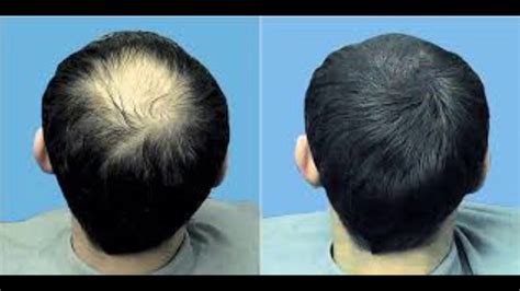 From $449 per 1 session. Micro Needling For Hair Loss | Spefashion