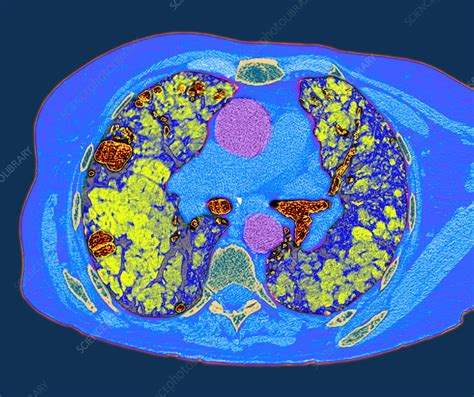 Lung Fibrosis Ct Scan Stock Image M1600064 Science Photo Library