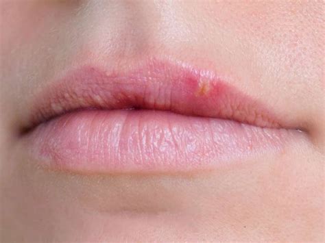 What Can Cause A Bump On The Lip Blister On Lip How To Line Lips