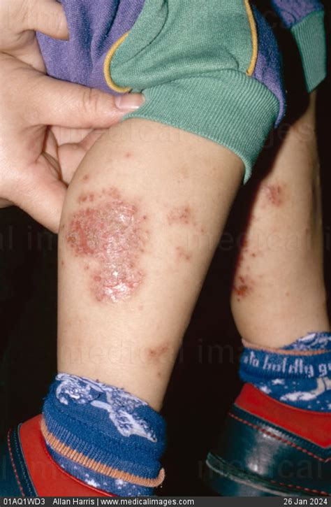 Stock Image Dermatology Infected Eczema Large Patch Of Dry And Scaly