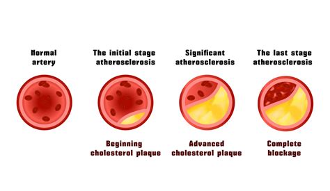 What Is Arterial Plaque Pad Treatment Centers Usa Vascular Centers