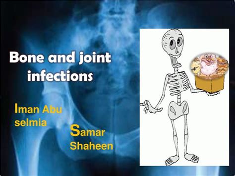 Ppt Bone And Joint Infections Powerpoint Presentation Free Download