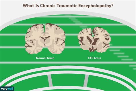 Chronic Traumatic Encephalopathy Cte Symptoms And More