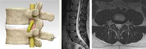 Lumbar Foraminal Stenosis Classification That Guides Surgical Treatment