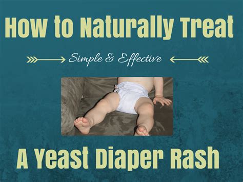 How To Naturally Treat A Yeast Diaper Rash Yeast Diaper Rash Diaper