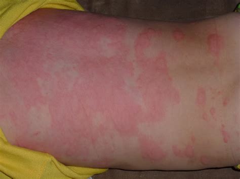 Rashes From Viruses Pictures Photos