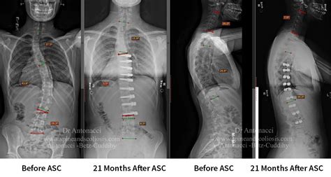 Scoliosis X Ray Before And After