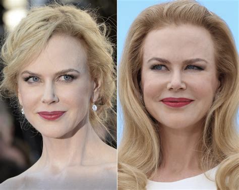 Nicole Kidman Plastic Surgery Before And After Latest Plastic Surgery