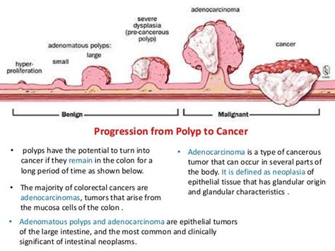 Malignant And Benign Tumors The Stages And Grading Of Tumor Type
