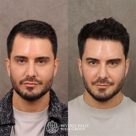 Hair Transplant And Hairline Lowering Before And Afters Beverly Hills