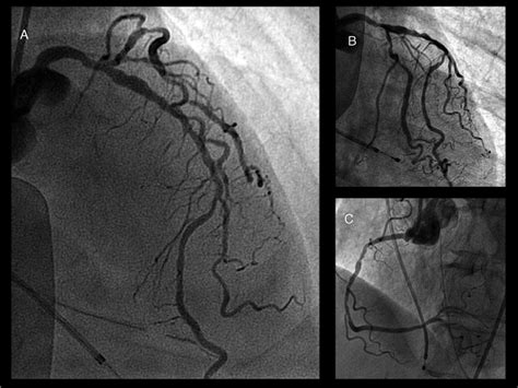 Coronary Angiogram A Left Anterior Descending Artery With Diffuse