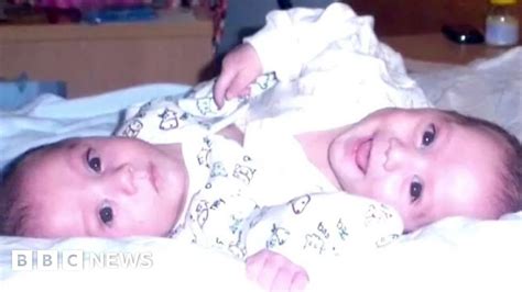 conjoined twins defying the odds to survive r medical news