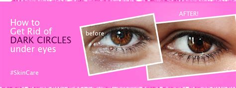 How To Get Rid Of Dark Circles Under Eyes Fast Diy Remedy