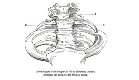 Why Cervical Ribs Extra Ribs Are Most Likely Not The Cause Of Your