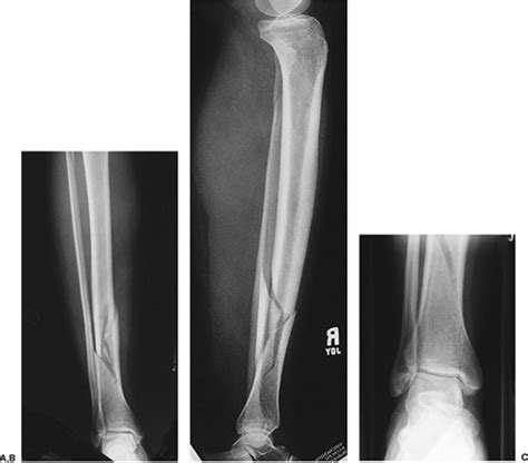 Tibial Shaft Fractures Open Reduction Internal Fixation Teachme