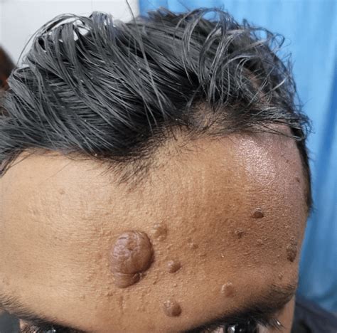 19 Year Old Male With Skin Lesions Since Age 4 And New Onset T1dm Cme
