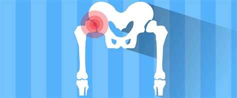 Total Hip Replacement: Exercises for an Earlier Return to Normal Gait | Total hip replacement ...