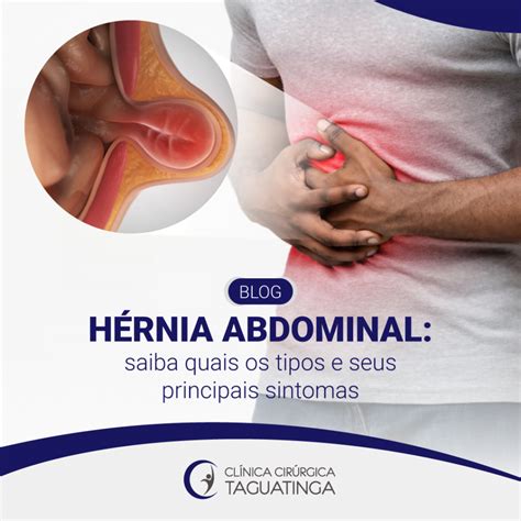 Hérnia abdominal saiba quais os tipos e seus principais sintomas Clínica Cirúrgica Taguatinga