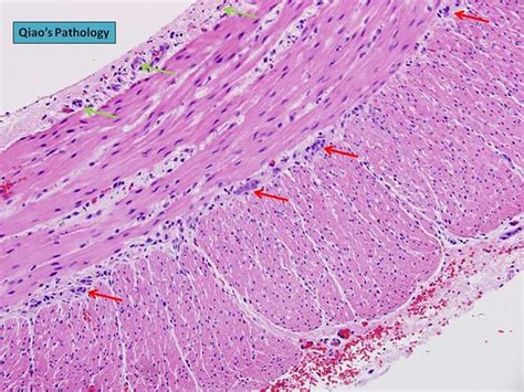 Learn the definition of 'auerbach's plexus'. Qiao's Pathology: Parasympathetic Ganglion Cells in ...