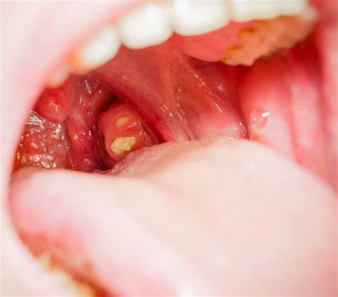 White Spots On Tonsils Causes Symptoms Treatment Pictures