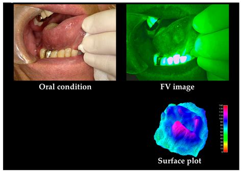 Cancers Free Full Text Non Invasive Early Detection Of Oral Cancers