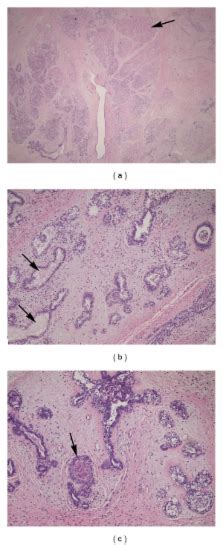 Vulvar Fibroadenoma With Lactational Changes In Ectopic Breast Tissue