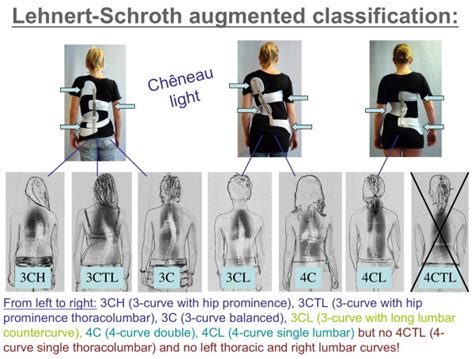 the augmented classification according to lehnert schroth curvatures download scientific